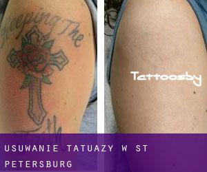 Usuwanie tatuaży w St.-Petersburg