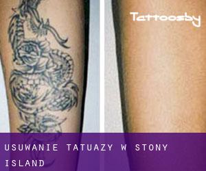 Usuwanie tatuaży w Stony Island