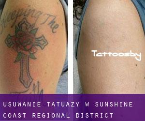 Usuwanie tatuaży w Sunshine Coast Regional District