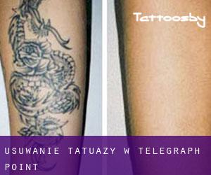 Usuwanie tatuaży w Telegraph Point
