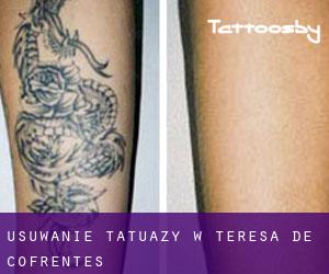 Usuwanie tatuaży w Teresa de Cofrentes
