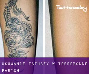 Usuwanie tatuaży w Terrebonne Parish