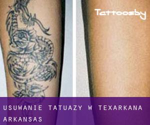 Usuwanie tatuaży w Texarkana (Arkansas)