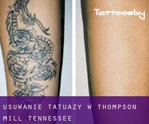 Usuwanie tatuaży w Thompson Mill (Tennessee)