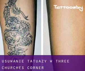 Usuwanie tatuaży w Three Churches Corner