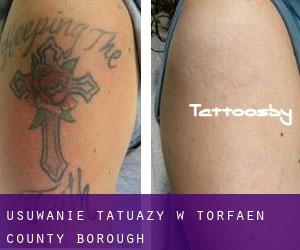 Usuwanie tatuaży w Torfaen (County Borough)
