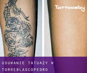 Usuwanie tatuaży w Torreblascopedro