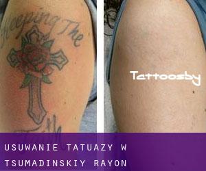 Usuwanie tatuaży w Tsumadinskiy Rayon