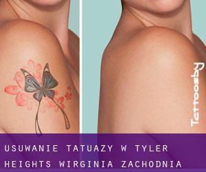 Usuwanie tatuaży w Tyler Heights (Wirginia Zachodnia)