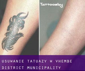 Usuwanie tatuaży w Vhembe District Municipality