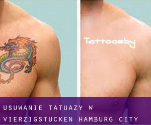 Usuwanie tatuaży w Vierzigstücken (Hamburg City)