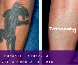 Usuwanie tatuaży w Villahermosa del Río