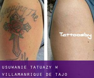 Usuwanie tatuaży w Villamanrique de Tajo