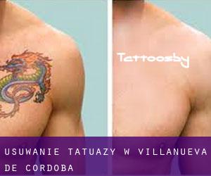 Usuwanie tatuaży w Villanueva de Córdoba