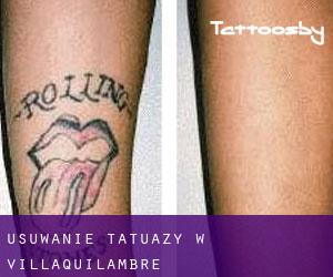 Usuwanie tatuaży w Villaquilambre
