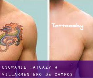 Usuwanie tatuaży w Villarmentero de Campos