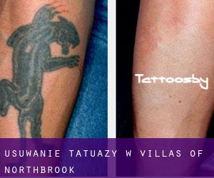 Usuwanie tatuaży w Villas of Northbrook