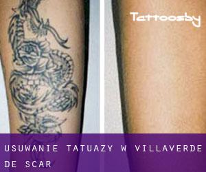Usuwanie tatuaży w Villaverde de Íscar