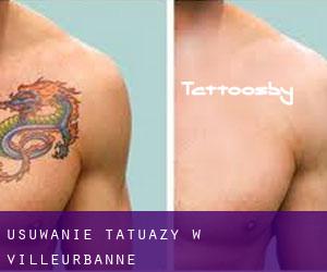 Usuwanie tatuaży w Villeurbanne
