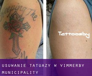Usuwanie tatuaży w Vimmerby Municipality