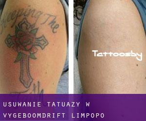 Usuwanie tatuaży w Vygeboomdrift (Limpopo)