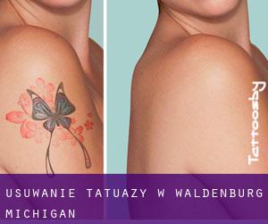 Usuwanie tatuaży w Waldenburg (Michigan)