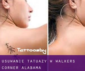 Usuwanie tatuaży w Walkers Corner (Alabama)