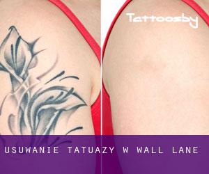 Usuwanie tatuaży w Wall Lane