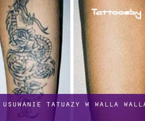 Usuwanie tatuaży w Walla Walla