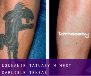 Usuwanie tatuaży w West Carlisle (Teksas)