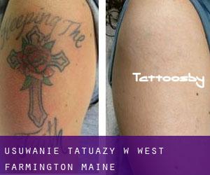 Usuwanie tatuaży w West Farmington (Maine)