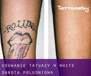 Usuwanie tatuaży w White (Dakota Południowa)