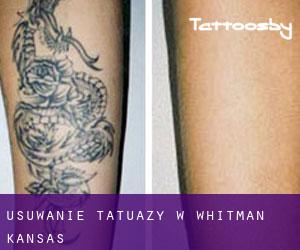 Usuwanie tatuaży w Whitman (Kansas)