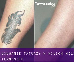 Usuwanie tatuaży w Wilson Hill (Tennessee)