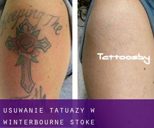 Usuwanie tatuaży w Winterbourne Stoke