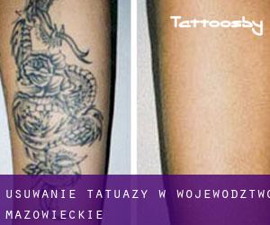 Usuwanie tatuaży w Województwo mazowieckie
