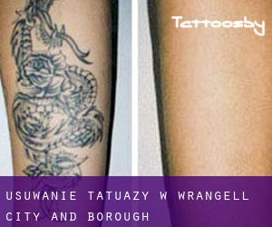Usuwanie tatuaży w Wrangell (City and Borough)