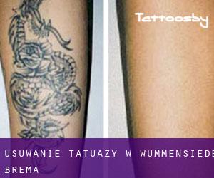 Usuwanie tatuaży w Wummensiede (Brema)