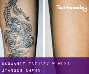 Usuwanie tatuaży w Wuxi (Jiangsu Sheng)