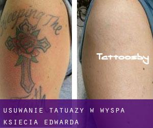 Usuwanie tatuaży w Wyspa Księcia Edwarda