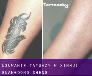 Usuwanie tatuaży w Xinhui (Guangdong Sheng)