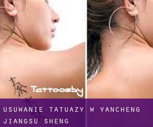 Usuwanie tatuaży w Yancheng (Jiangsu Sheng)