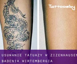 Usuwanie tatuaży w Zizenhausen (Badenia-Wirtembergia)